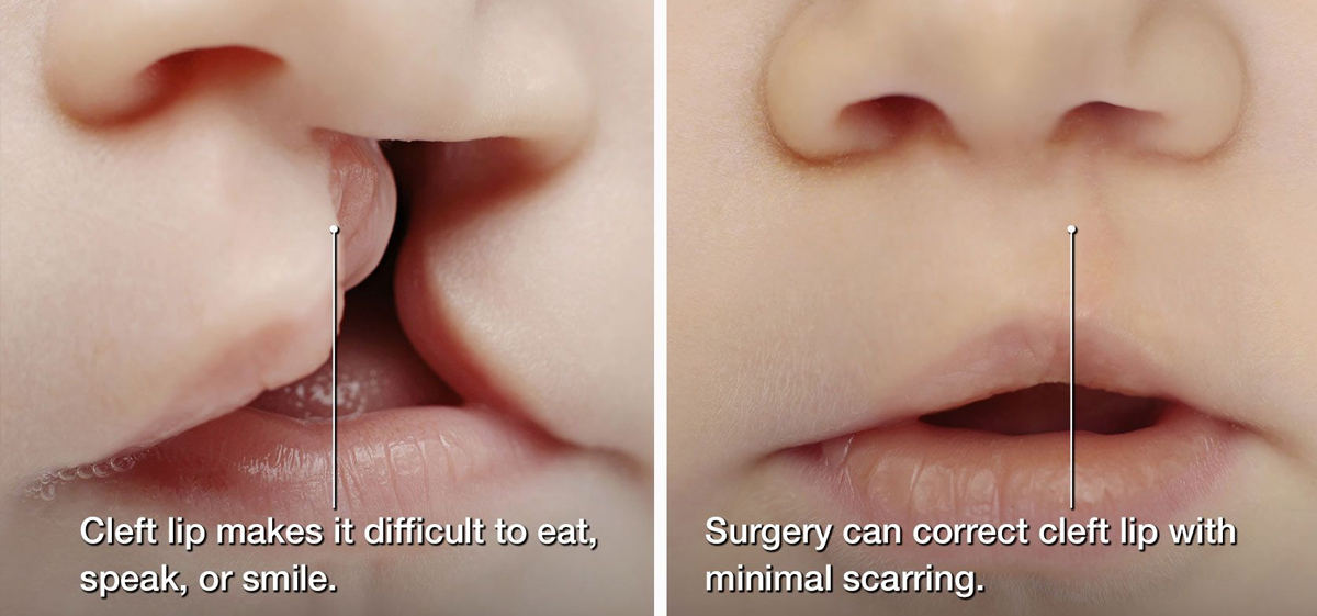 Cleft Lip & Palate Surgery